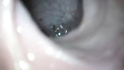 Исследование прямой кишки через анал камерой